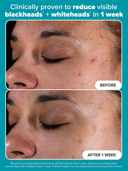 Paula's Choice SKIN PERFECTING 2% BHA Liquid Exfoliant with Salicylic Acid