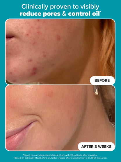 Paula's Choice SKIN PERFECTING 2% BHA Liquid Exfoliant with Salicylic Acid